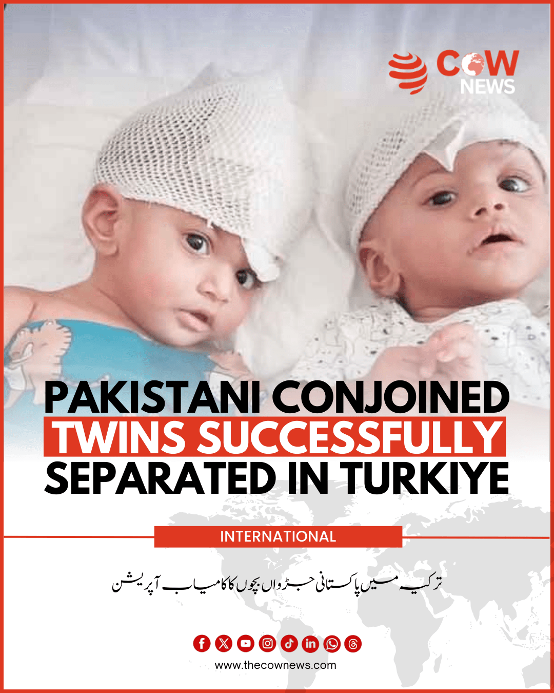 Pakistani Conjoined Twins Successfully Separated in Turkiye