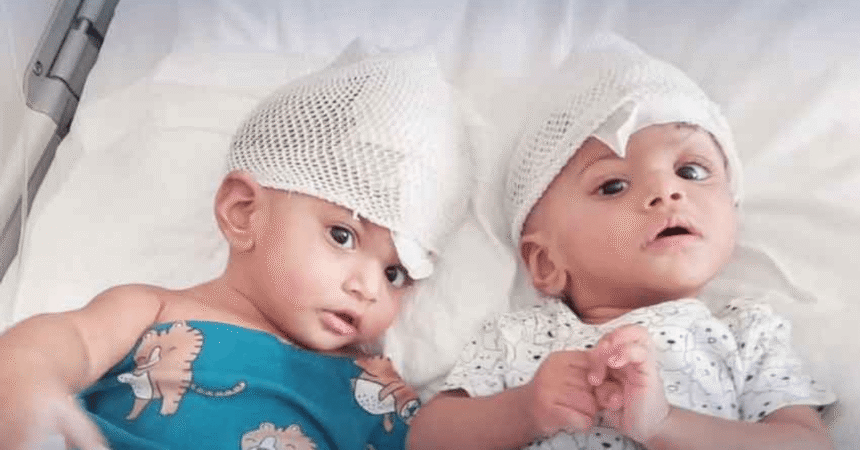 Pakistani Conjoined Twins Successfully Separated in Turkiye